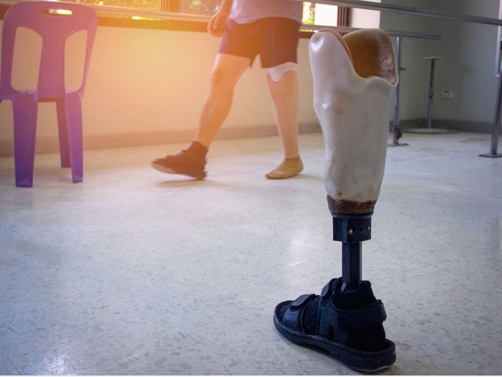 Picture of Providing artificial limbs - Jordan