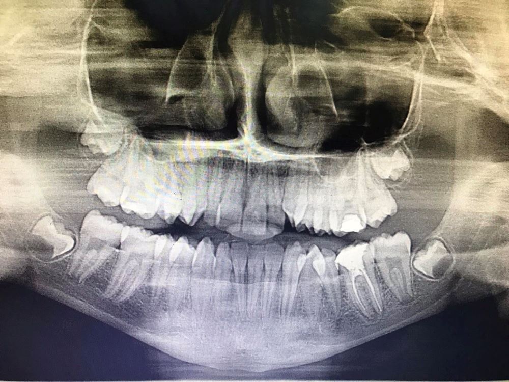 صورة علاج  تزاحم الاسنان لليتيمة بيتا